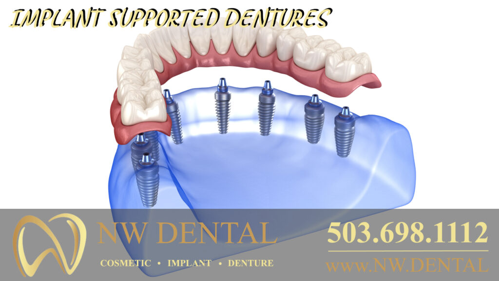 Clackamas Dentist Cosmetic and Emergency dentists implant supported dentures in Clackamas Oregon