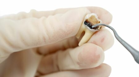 How Long Does it Take for a Cavity to Form?
