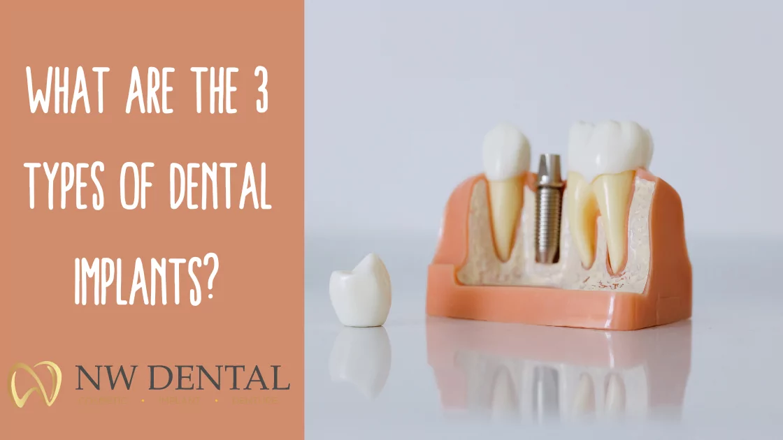 What are the 3 Types of Dental Implants